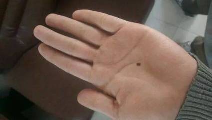 有“痣”者，須注意！磨擦可能帶來的健康風險